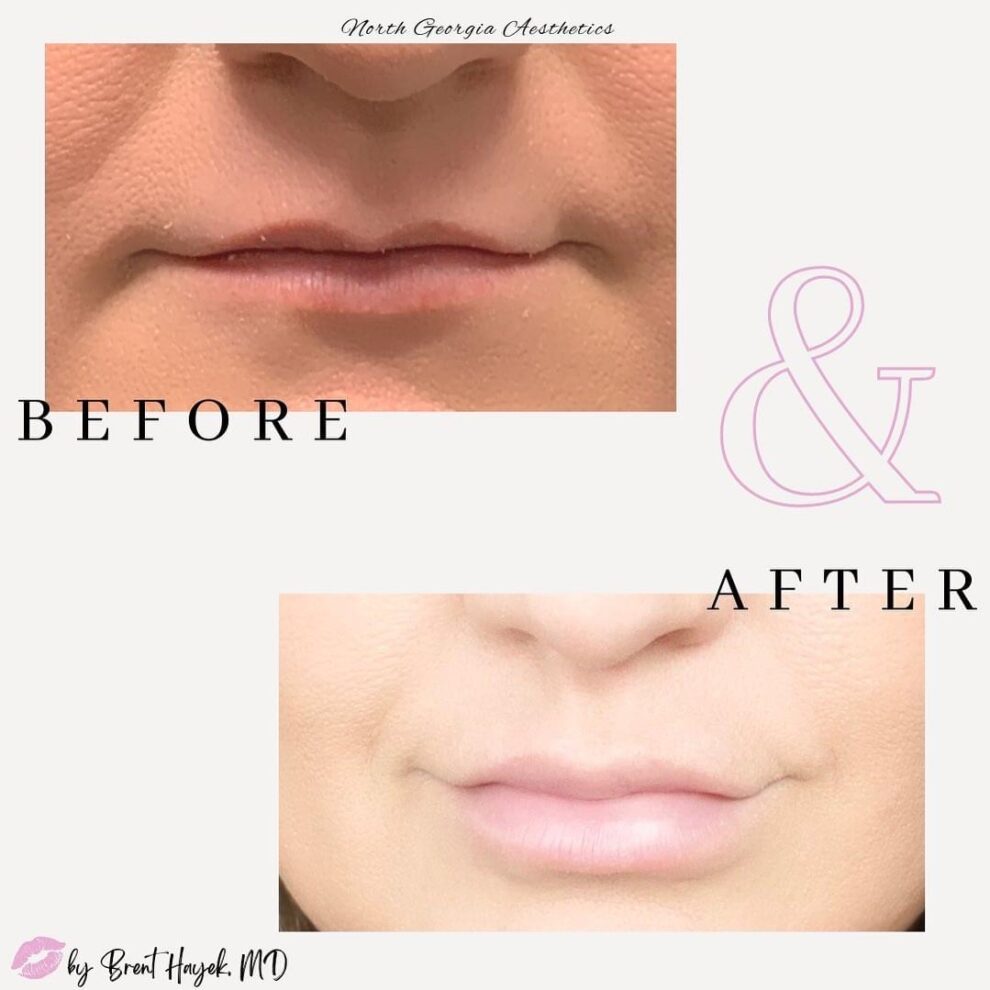 Before & After Gallery Lips North Georgia Aesthetics