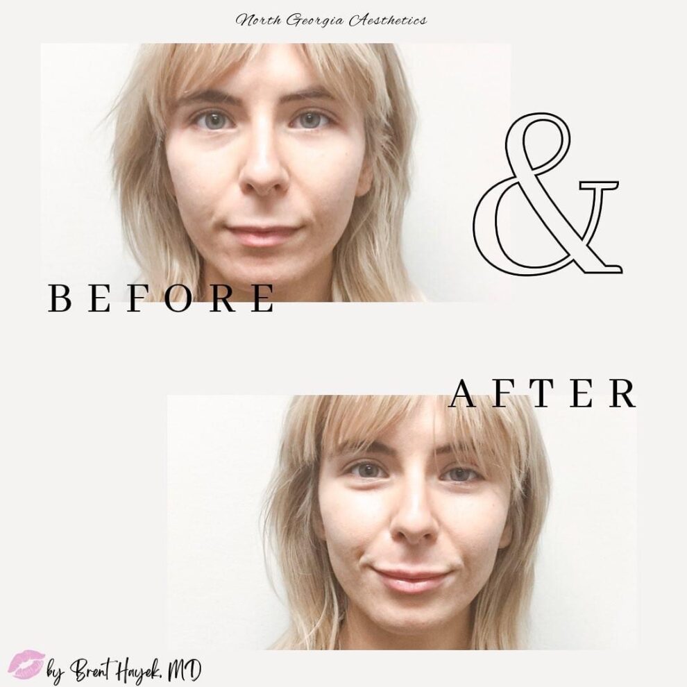 Before & After Gallery North Georgia Aesthetics