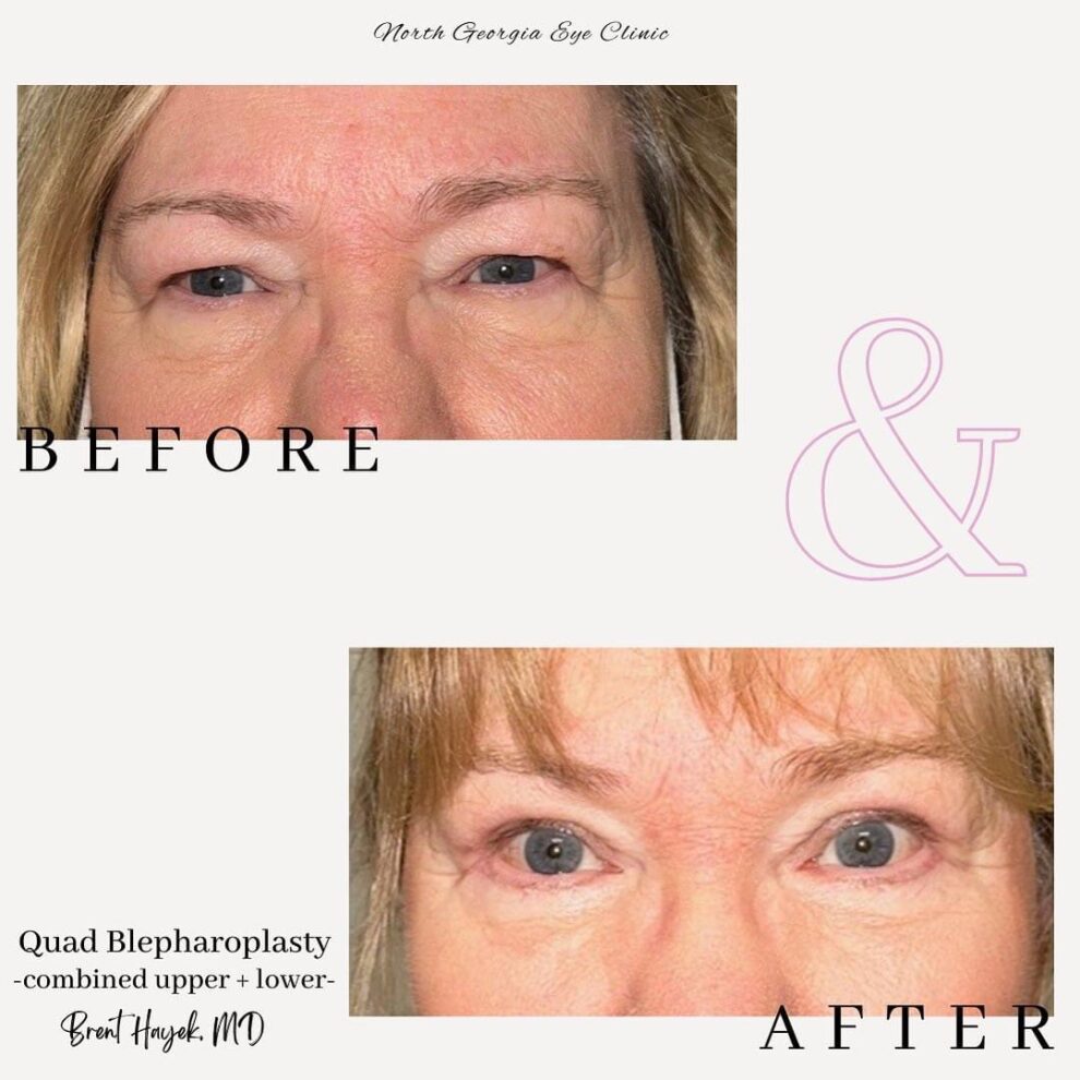 Before & after gallery North Georgia Aesthetics quad blepharoplasty combined upper and lower lids