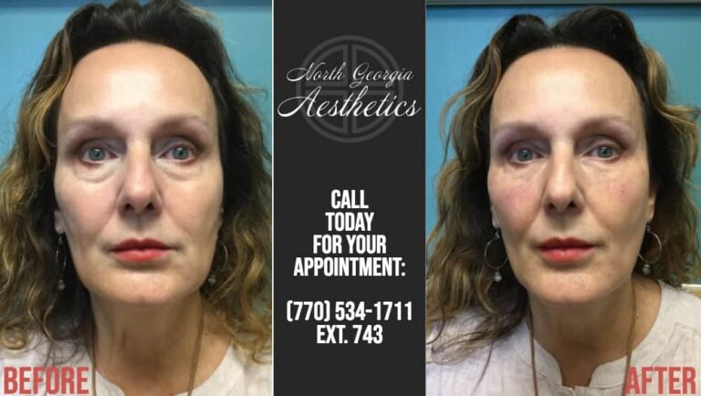 No-Downtime Under Eye Fillers Before and After
